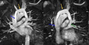 A e B. Angiografia (em reconstrução multiplanar): seta azul: veia cava superior; seta amarela: veia inominada; seta branca: veia pulmonar anómala vertical; seta verde: veias pulmonares esquerdas.
