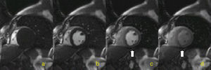 Sequência IR-SSFP imagem no eixo curto. (a-d) Defeito de perfusão da parede inferior (seta). Notar a chegada de contraste ao ventrículo direito (a), ao ventrículo esquerdo (b) e o realce progressivo do miocárdio (c-d).