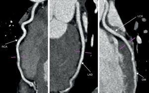 Cardiac computed tomography: multiplanar reconstructions ruling out significant coronary artery disease. LAD: left anterior descending artery; LCX: left circumflex artery; OM: obtuse marginal artery; RCA: right coronary artery.