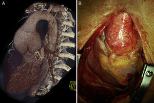 Aortic root dilatation seen in cardiac computed tomography volume-rendered image (A) and in intraoperative photograph (B).