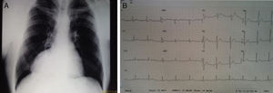 (A) Chest X-ray showing pericardial cyst projecting into the right costophrenic angle mimicking dextrocardia; (B) ECG without abnormalities suggesting dextrocardia.