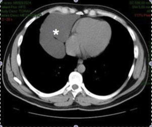 Large mass (*) in the right costophrenic angle on CT scan.