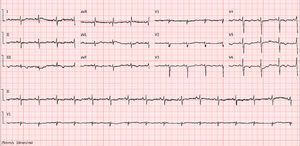 Electrocardiogram (ECG) showing ST-segment depression and T-wave inversion in the precordial and inferior leads. Importantly, detailed retrospective analysis of the admission ECG reveals a shift of the frontal QRS to the right, with a prominent S wave in lead I and an inverted T wave in lead III, as well as low QRS voltage in the right precordial leads and a pseudoinfarction pattern (Qr in V1 with poor R-wave progression/excessive clockwise rotation with rS up to V6), an indication of right ventricular overload/injury.