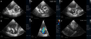 Transthoracic echocardiogram in left parasternal short-axis view depicting a dilated right ventricle with leftward septal shift, suggestive of right ventricular pressure overload (A). Parasternal short-axis view of the basal right ventricle (RV) (B) and RV modified apical 4-chamber view (C and D) showing a dilated right ventricle and a free-floating right atrial mass (about 4.01 × 1.96 cm). Severe tricuspid regurgitation due to annular dilatation (E) and dilated inferior vena cava with no respiratory variation (F) are also shown; estimated systolic pulmonary pressure was 54 mmHg (not shown). The findings were highly suggestive of acute pulmonary embolism with incidental right heart thromboembolus in transit.