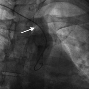 Aortic arch angiography. Takeoff of large vessels from the aortic arch via a single trunk (white arrow).