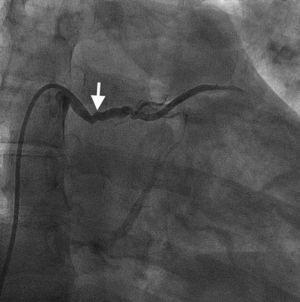 Coronary venous-cameral fistula. Using a 5-Fr MP diagnostic catheter, angiography of the coronary-venous cameral fistula (white arrow) was performed. The fistula itself drains into the high RA.