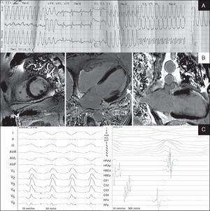 A) Admission ECG demonstrating a monomorphic ventricular tachycardia; B) CMR images in short axis, long axis and four-chambers views obtained after gadolinium injection demonstrating transmural gadolinium enhancement in mid-apical anterior and lateral segments; C) morphology of ventricular tachycardia during the electrophysiological study and left ventricular endocardial mapping.