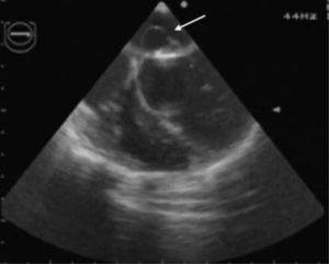 Plano 4 câmaras de um ecocardiograma transesofágico mostrando uma imagem sugestiva de abcesso (seta) localizado no folheto anterior da válvula mitral.