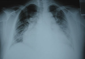 Radiografia de tórax.