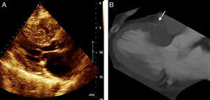 Painel A: Ecocardiograma transtorácico bidimensional em plano paraesternal eixo longo em diástole. Painel B: A mesma projeção por TC cardíaca em Multiplanar reconstruction (MPR) com 12mm de espessura, durante a diástole.