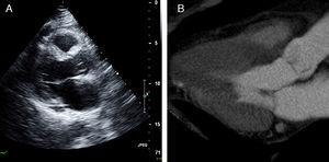Painel A: Ecocardiograma transtorácico bidimensional em plano paraesternal eixo longo em sístole. Painel B: TC cardíaca com MPR (12mm) em plano de 3 câmaras durante a sístole (25% do ciclo cardíaco).