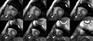 Balanced steady-state free precession (b-SSFP) cine images depicting the left ventricle at end-diastole in short-axis views from base to apex. Note the increased septal wall thickness and the metallic artefact from the pacemaker generator (arrows) and lead (arrowheads).