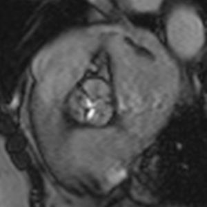 b-SSFP cine image of the aortic valve at end-systole, showing moderate aortic stenosis.