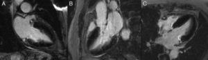 Inversion recovery delayed enhancement images in 2-, 3- and 4-chamber views (A, B and C, respectively) demonstrating the absence of areas of hyperenhancement.
