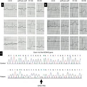 (A) and (B) The first two electrocardiograms, with corrected QT interval between 428 and 468 ms. (C) The novel mutation identified in exon 4 of the KCNH2 gene.
