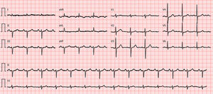 Admission 12-lead electrocardiogram showing no relevant ST-segment changes.