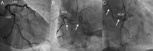 (A): coronary angiography depicting no obstructive epicardial disease in the left dominant coronary circulation. (B and C): the right coronary artery was a small caliber vessel, with significant tortuosity in its proximal segment, but with no obstructive disease. An abnormal vessel was noted (arrows) arising from its proximal course and heading left, toward a posterior-superiorly located structure. LAD: left anterior descending artery; LCx: left circumflex artery; RCA: right coronary artery.