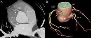 Multislice computed tomography. (A): 2D multiplanar reformatted image revealing a fistulous connection (arrows) between the proximal right coronary artery (RCA) and the left atrium (LA). (B): 3D volume-rendered image showing the fistula (arrows) arising from the proximal right coronary artery with a retro-aortic course. RA: right atrium; RVOT: right ventricular outflow tract.