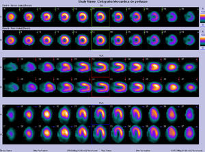 Exercise single-photon emission computed tomography using standard Bruce protocol (8:43 minutes achieving 85% of the age-predicted maximum heart rate, 10.1 metabolic equivalents) showing no residual ischemia.
