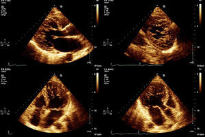 Imagens de ecocardiograma bidimensional de um doente com NCIVE (em cima, paraesternal eixo longo e eixo curto; em baixo, apical 4 câmaras e apical eixo longo).