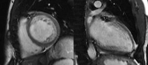 Imagens de RMN cardíaca de um doente com NCIVE (eixo curto à esquerda e eixo longo 2 câmaras à direita, sequência CINE).