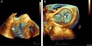 Three-dimensional transesophageal echocardiography. (A) Full volume cropped image showing the detached head of the anterior papillary muscle inside the LV (arrow) causing severe prolapse of the posterior leaflet; (B) 3D Zoom of the mitral valve showing prolapse of the P1 and P2 segments. LA: left atrium; LV: left ventricle; Ao: aortic valve; LAA: left atrial appendage.