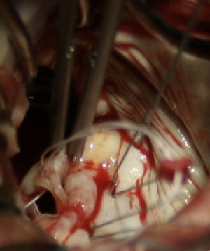 Intraoperative view showing the forceps holding the detached muscle head. The two primary cords connecting the muscle head to the edge of the posterior leaflet are clearly seen.