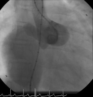 Aortogram with a 5 Fr pigtail angiographic catheter showing drainage of the fistula into the RA through two separate orifices.
