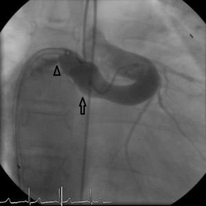 Angiography in the fistula with the device still attached (arrow), showing drainage into the RA through a second orifice (arrowhead).