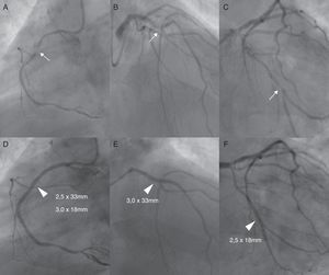 Top: Left anterior oblique view of the mid-right coronary artery critical stenosis (Panel A), right anterior oblique cranial view of the mid-left anterior descending artery critical stenosis (Panel B) and right anterior oblique caudal view of the second obtuse marginal critical stenosis (Panel C). Bottom: Angiographic result after PCI with balloon predilatation and implantation of sirolimus-eluting stents (arrowheads) (D–F).