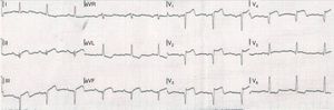 Electrocardiogram on admission with ST-segment elevation in anteroseptal and inferior leads.