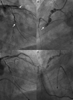 Dramatic simultaneous very late stent thrombosis of the left anterior descending, second obtuse marginal and right coronary arteries (A and B). Note the extensive positive remodeling with several aneurysms in the non-stented proximal right coronary artery reference segments (B and D). Suboptimal reperfusion and no-reflow phenomenon after thrombus aspiration, multiple balloon dilations, administration of intracoronary platelet glycoprotein IIb/IIIa receptor inhibitors and adenosine, right ventricular endocavitary pacing and intra-aortic balloon pump counterpulsation (C and D).