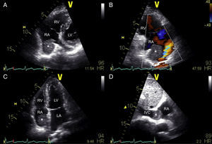 Transthoracic echocardiography study showing a right atrial mass located near the inferior vena cava opening (A and B – non-conventional views, C – apical 4-chamber view, D – subcostal view) and flow acceleration at the confluence with the right atrium (B). *: right atrial mass; IVC: inferior vena cava; LA: left atrium; LV: left ventricle; RA: right atrium; RV: right ventricle.