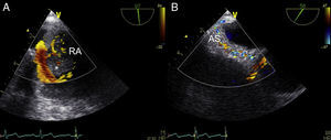 Transesophageal echocardiography study with color Doppler showing the rich vascularization of the mass (A) and of the residual atrial septum (B). *: right atrial mass; AS: atrial septum; RA: right atrium.