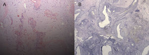 (A) Conventional view of a cardiac myxoma (hematoxylin and eosin stain ×100). (B) Anomalous vascularization (elastic van Gieson stain ×40).