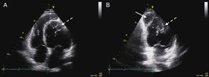 Transthoracic echocardiogram. (A) Apical 4-chamber view; (B) apical 2-chamber view. Solid arrow: right ventricle. Dashed arrow: network of papillary muscles.