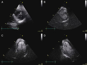 (A) Transthoracic echocardiogram, parasternal short-axis view. Contrast transthoracic echocardiogram: (B) parasternal short-axis view; (C) apical 4-chamber view; (D) apical 3-chamber view.