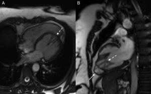 Cardiac magnetic resonance. Steady-state free precession images in horizontal long-axis view (A) and vertical long-axis view (B). Solid arrow: right ventricle. Dashed arrow: network of papillary muscles.