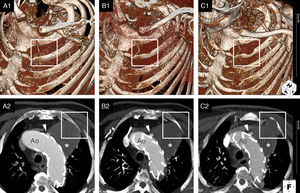 ECG-gated cardiac computed tomography of our patient showing the natural history of a left untreated type 1 endoleak (arrowhead) at the proximal edge of a stent-graft in the aortic arch (Ao). Upper panel (A1–C1) presents three-dimensional reconstructions (volume-rendering technique); lower panel (A2–C2) presents the corresponding images in the axial plane (maximum intensity projection). Over time (from A to C), the aneurysmal sac (*) continued to be pressurized and expanded towards the chest wall, ultimately causing erosion of the second left rib (box).