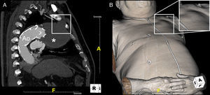 Pulsatile mass in the left chest wall noticed by the patient (B, with detail in box) and corresponding sagittal CT image (A) showing a giant aneurysm (*) measuring 70 mm×75 mm×95 mm expanding through the first left intercostal space (box).