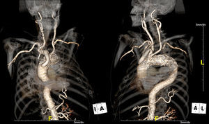 Performed hybrid technique in three-dimensional reconstructions: surgical extra-anatomic ascending aorta-to-brachiocephalic bypass (the patient presented a common origin of the brachiocephalic trunk and left common carotid artery) followed by endovascular insertion of an additional prosthesis in the ascending aorta-aortic arch transition.