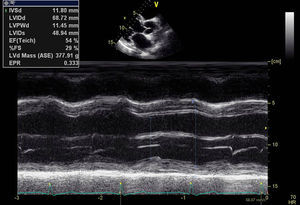 Plano paraesternal esquerdo longo eixo, avaliação em modo M: ventrículo esquerdo dilatado com diâmetros telediastólico de 69mm e telessistólico de 49mm.