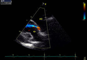 Plano supraesternal, com estudo Doppler a cor: fluxo da aorta para a artéria pulmonar. AO: aorta; AP: artéria pulmonar.