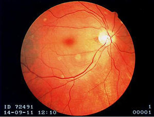 Right eye fundoscopic examination showing a pale retina with a cherry-red macula.