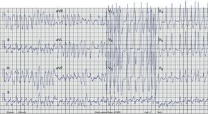 Presenting 12-lead <span class=