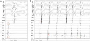 Accessory pathway ablation. Surface leads I, II, III, aVF, aVL, aVF and V1–V6 are shown, with intracardiac recordings from catheters in the right ventricle (HRVp and HRVd), distal (CS1) and proximal (CS5) coronary sinus, and proximal (RFp) and distal (RFd) ablation catheter. Atrial (A) and ventricular (V) electrical signals are shown. (A) Electrocardiographic and intracardiac signals immediately before catheter ablation, recorded at 200mm/s. (B) Catheter accessory pathway ablation, recorded at 50mm/s. Conduction over the AP disappeared within 3s of radiofrequency energy application. The asterisk represents the beginning of radiofrequency energy application.