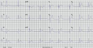 Twelve-lead <span class=