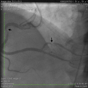 Coronary angiogram of the right coronary artery (RCA) showing 80% lesion of the mid-RCA and 90% lesion of the mid posterolateral ventricular branch (black arrows).