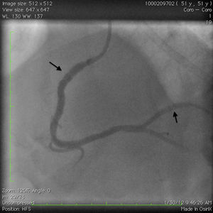 Coronary angiogram of the right coronary artery showing optimal result after stent placements (black arrows).