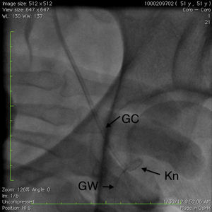 Knotted, fractured guiding catheter with 0.014 inch wire inside, in the proximal external iliac artery. GC: guiding catheter; Kn: knot; GW: guidewire.
